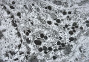 M,42y. | malignant mesothelioma - pleura M,42y. | malignant mesothelioma - pleura